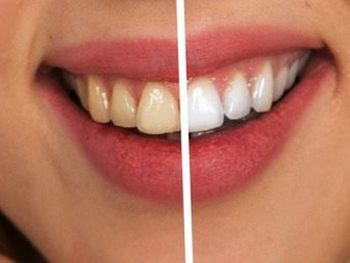TOP 3 cách làm trắng răng tự nhiên nhanh chóng, hiệu quả