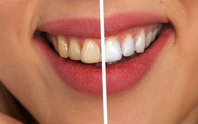 TOP 3 cách làm trắng răng tự nhiên nhanh chóng, hiệu quả